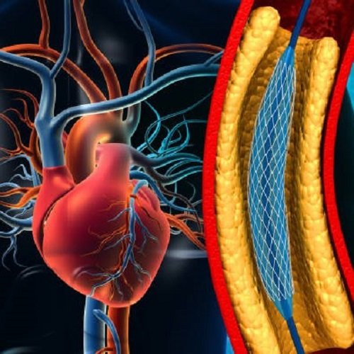 Congenital Heart Disease Catheterization