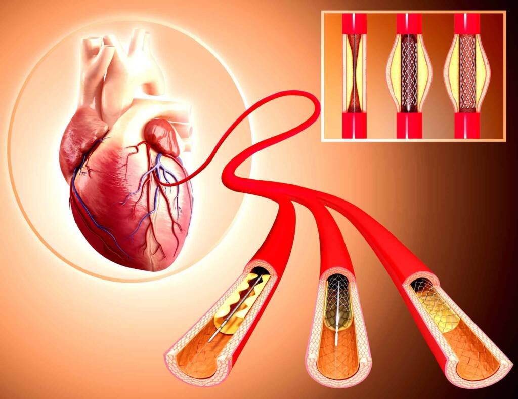 Congenital Heart Disease Catheterization