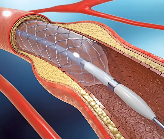 Congenital Heart Disease Catheterization